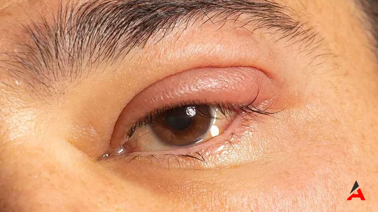 Göz Kapanması: Sebepleri, Belirtileri ve Önleme Yolları