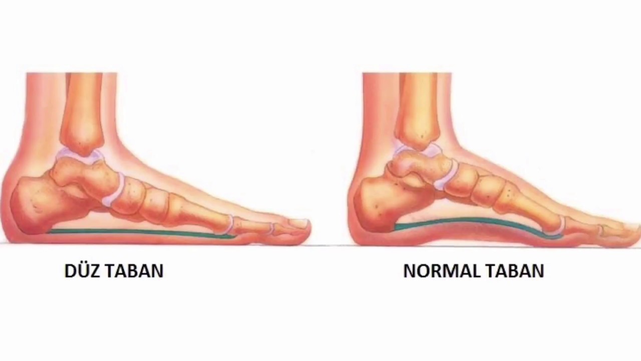 Düz Tabanlık Nedir? Belirtileri ve Doğru Ayakkabı Seçimi